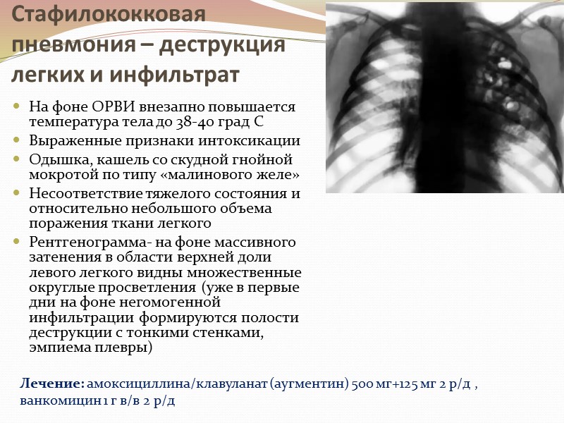 Стафилококковая пневмония – деструкция легких и инфильтрат На фоне ОРВИ внезапно повышается температура тела